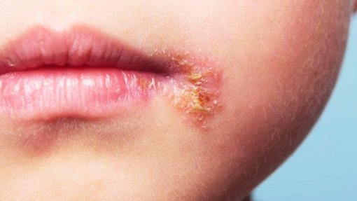 Herpes zóster leva ao internamento de uma pessoa a cada dois dias - estudo