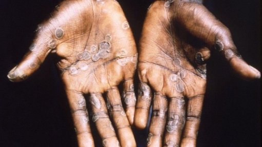 Mpox: África registou quase 78.000 casos e 1.321 mortes desde início de 2024