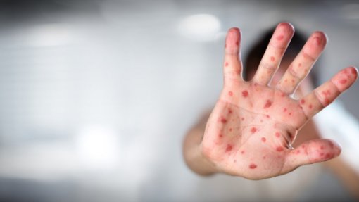 EUA: Adulto infetado com sarampo morre no Novo México