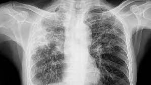 Portugal regista 1.584 casos de tuberculose em 2023, maior incidência em Lisboa e Norte