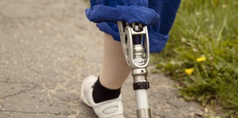Quénia faz primeira cirurgia mundial de restauro de sensibilidade a pacientes amputados