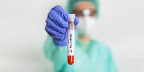 Mpox: Portugal é o sexto na Europa com mais casos entre 2022-2025 - relatório