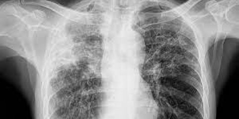 OMS estuda alargar laboratório de tuberculose de Maputo a estatuto regional
