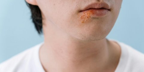 Investigação espanhola mostra como vírus do herpes labial remodela genoma humano