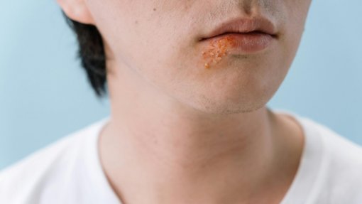 Investigação espanhola mostra como vírus do herpes labial remodela genoma humano