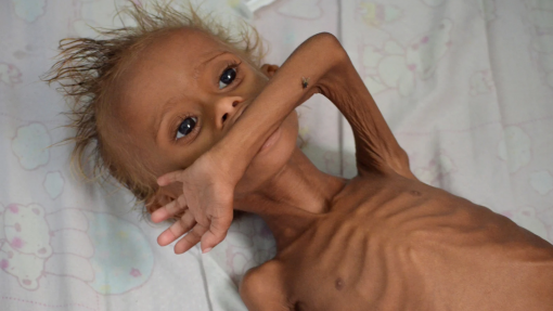 Médio Oriente: Mais de 5.000 crianças em Gaza sofreram de desnutrição aguda em maio - ONU