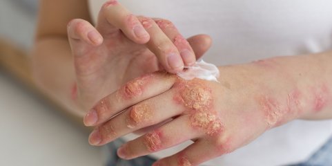 Enxertos de pele geneticamente modificada podem ajudar a tratar doença dermatológica