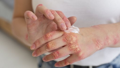 Enxertos de pele geneticamente modificada podem ajudar a tratar doença dermatológica