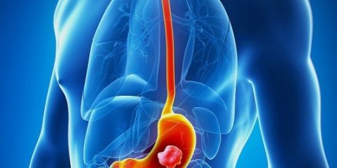 Estudo estima que 15,6 milhões de pessoas no mundo terão cancro gástrico