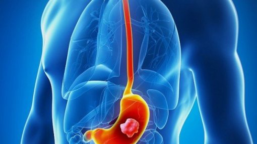 Estudo estima que 15,6 milhões de pessoas no mundo terão cancro gástrico