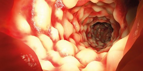 Investigadora do Porto coordena estudo para controlar doença de Crohn