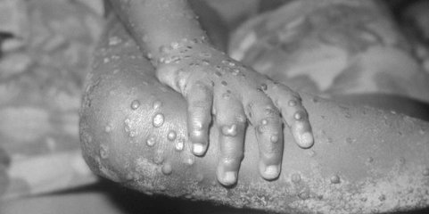 Mpox: Moçambique aposta na testagem local para conter surto