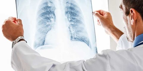 Associação critica falta de vontade política no rastreio do cancro do pulmão