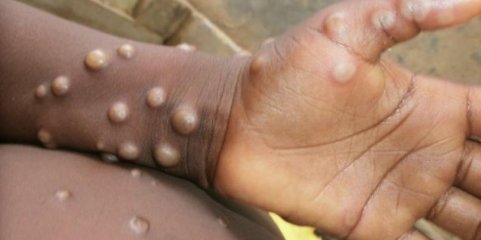 Mpox: Moçambique confirma mais dois casos em Maputo e 222 suspeitos