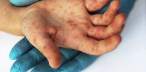 Mpox: Mais de metade dos casos já recuperados em Moçambique