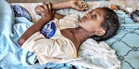 Etiópia lança iniciativa com ONU para acelerar prevenção da desnutrição infantil