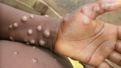 Mpox: OIM intensifica esforços para conter propagação na África ocidental e central