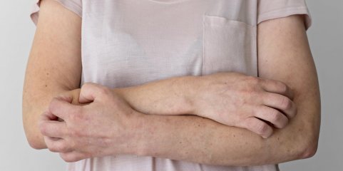 Espanha confirma primeiro caso de dermatite nodular contagiosa em exploração pecuária
