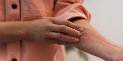 DGAV pede reforço da prevenção contra dermatose nodular face aumento de casos na UE