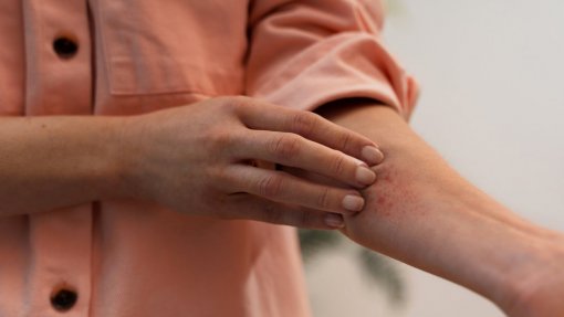 DGAV pede reforço da prevenção contra dermatose nodular face aumento de casos na UE