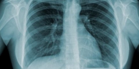 Detetado caso de tuberculose pulmonar num hotel na região de Lisboa - DGS