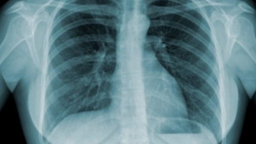 Detetado caso de tuberculose pulmonar num hotel na região de Lisboa - DGS