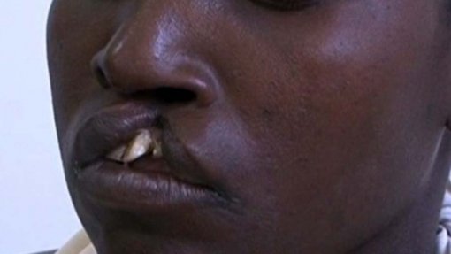 Fenda labial é um problema de saúde grave e transversal em Moçambique - ONG