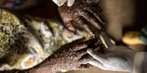 Mpox: Moçambique com 89 casos em três meses mas 70 já estão recuperados