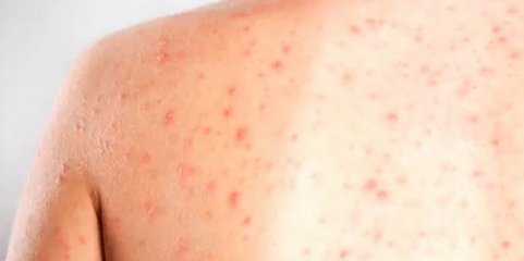 Canadá perde estatuto de país livre de sarampo detido há 27 anos