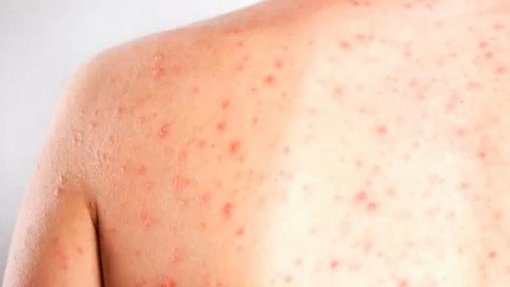 Canadá perde estatuto de país livre de sarampo detido há 27 anos