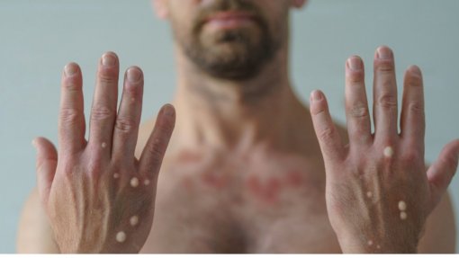 Identificado novo surto de mpox em Lisboa - GAT