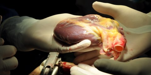 ULS Gaia/Espinho prepara-se para realizar transplante cardíaco no prazo de um ano