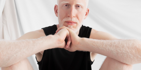 Albinismo não é compreendido em Portugal e faltam dados - Perita da ONU