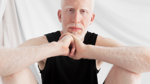 Albinismo não é compreendido em Portugal e faltam dados - Perita da ONU