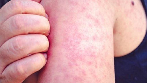 Região Africana reduz 40% dos casos e 50% das mortes por sarampo - OMS