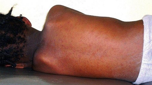 Surto de sarampo provocou 36 mortes desde setembro na província angolana de Malanje