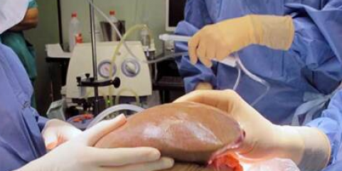 Homem doa dois órgãos à filha no primeiro transplante combinado de dador vivo em Itália