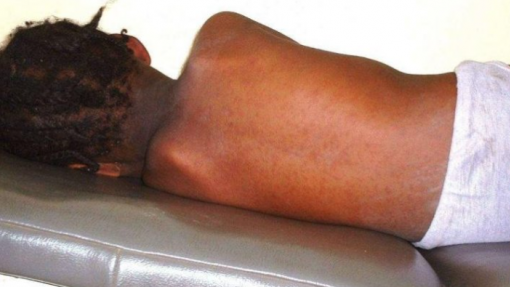 Moçambique com mais de 600 casos de sarampo e um morto em surto com seis meses