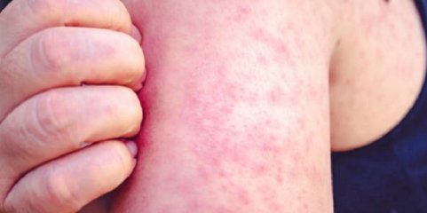 Sarampo com transmissão em países europeus e Portugal com 21 casos em 2025 - relatório