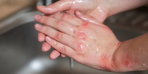 Três feridos graves em acidente com água a ferver em fábrica de Viana do Castelo