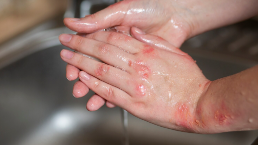 Três feridos graves em acidente com água a ferver em fábrica de Viana do Castelo