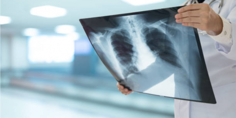 OMS recomenda novas ferramentas de diagnóstico para ajudar a erradicar a tuberculose