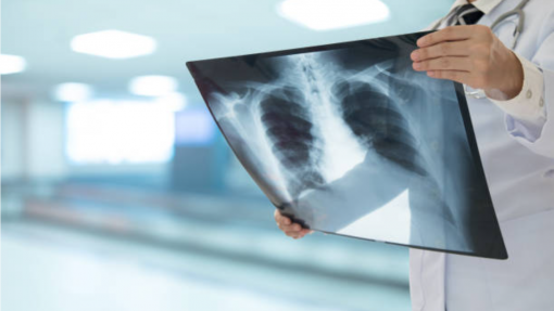 OMS recomenda novas ferramentas de diagnóstico para ajudar a erradicar a tuberculose