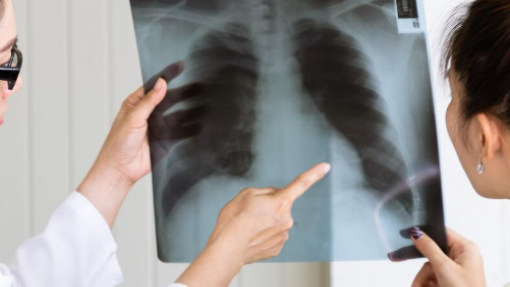 Taxa de mortalidade por tuberculose em Angola baixou para quase metade em 2025