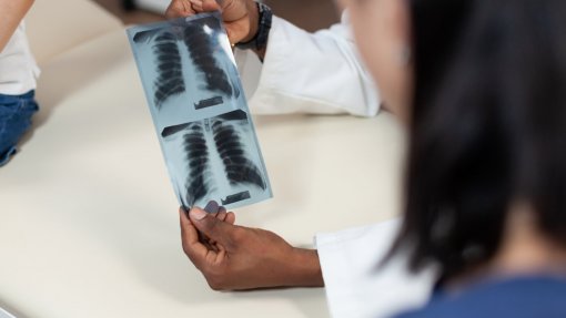 Liga Portuguesa Contra a Sida identifica 54 casos de tuberculose em 2.511 rastreios