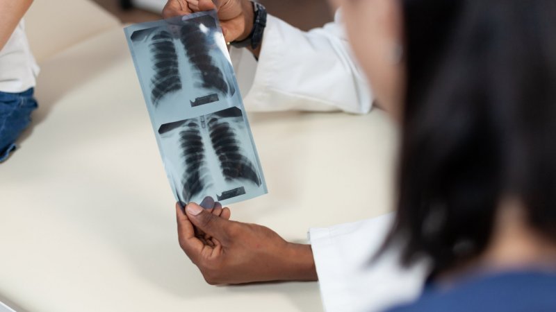 Liga Portuguesa Contra a Sida identifica 54 casos de tuberculose em 2.511 rastreios