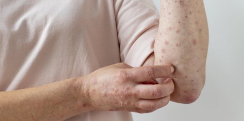 República Democrática do Congo declara o fim do surto de mpox