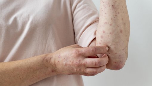 República Democrática do Congo declara o fim do surto de mpox