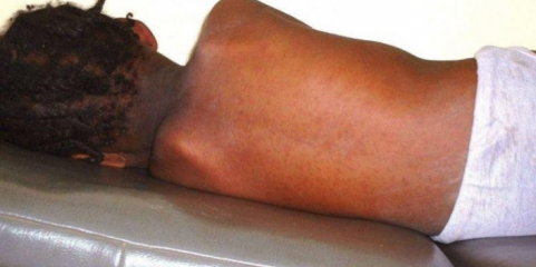 Sarampo causa 15 mortos em mais de 500 casos na província angolana do Cubango