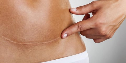 DGS reconhece que falta de dados impede panorama completo das cesarianas